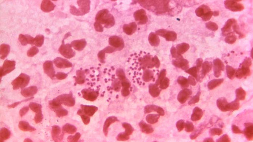 Zoliflodacin überzeugt in Phase-III-Studie